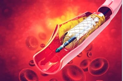 PCI stents