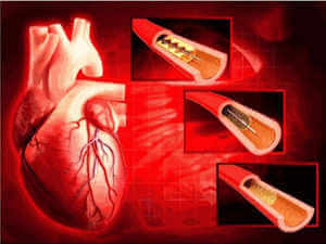 PCI stents