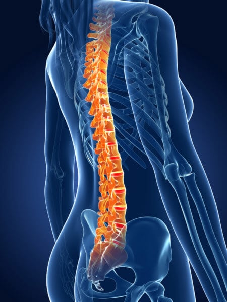 Posterior spinal fusion