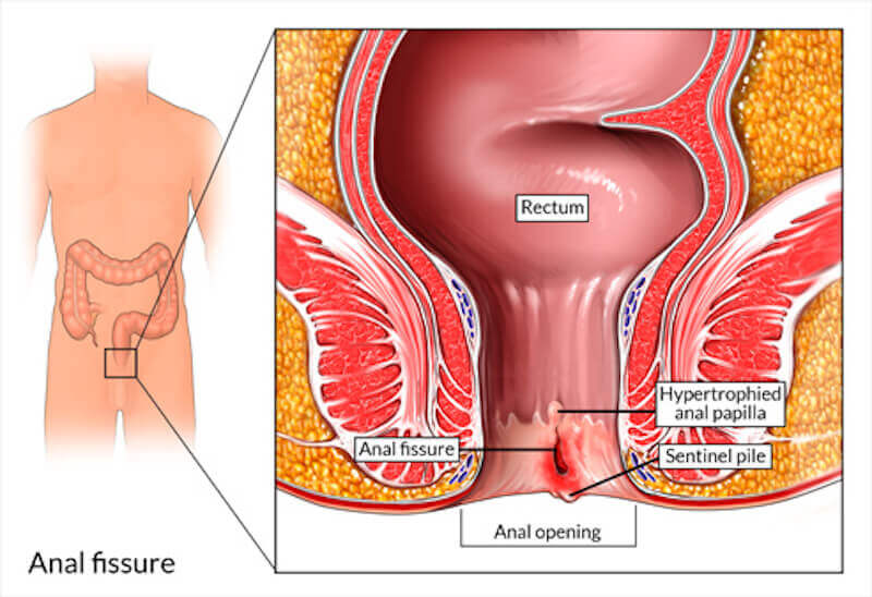 Hemorrhoids removal and anal fissures