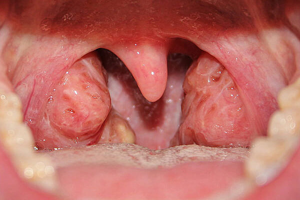 Tonsillectomy