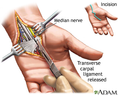 Carpal Tunnel Syndrome