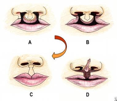 Cleft lip