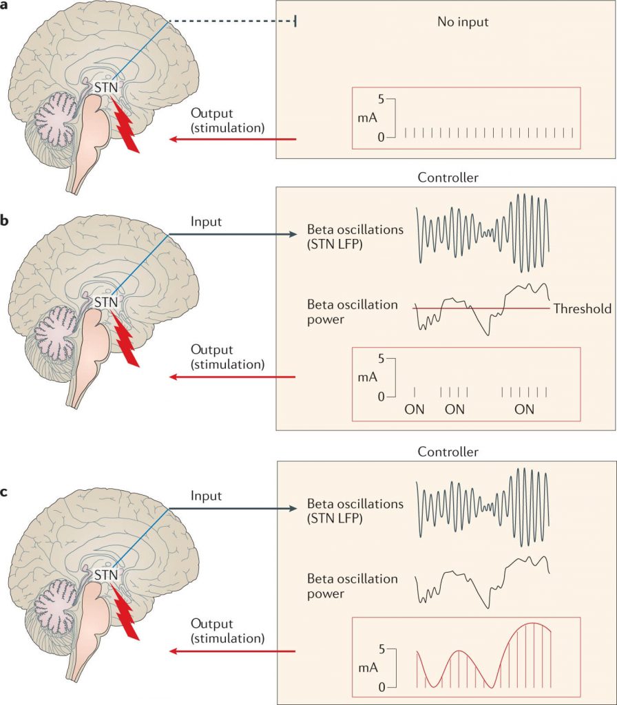 Deep brain stimulation (DBS)