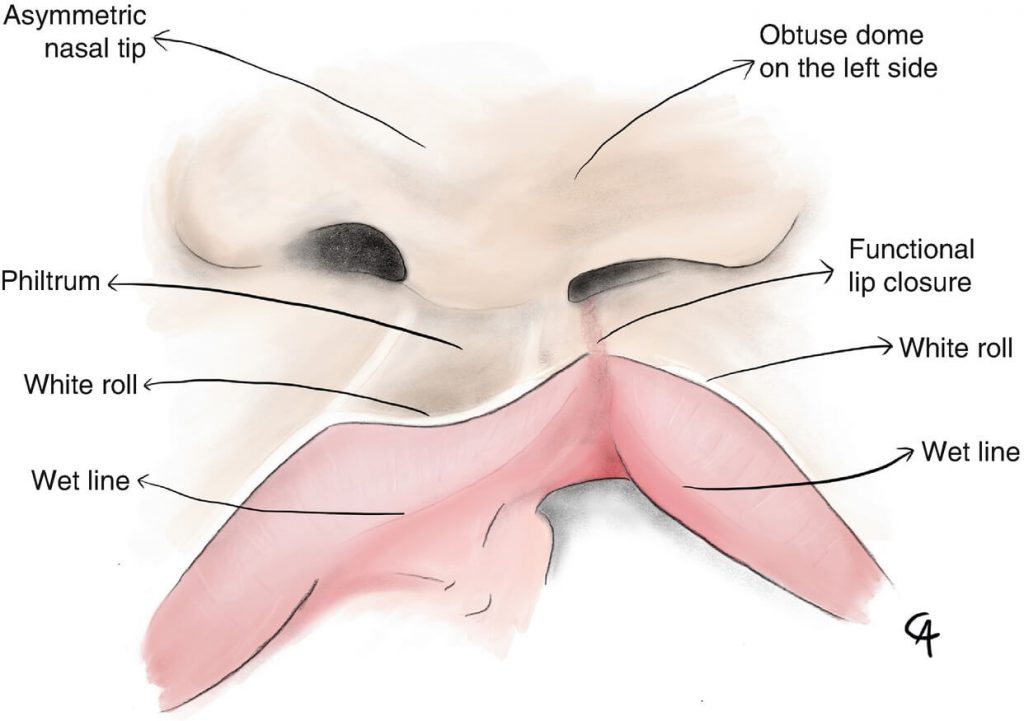 Cleft lip