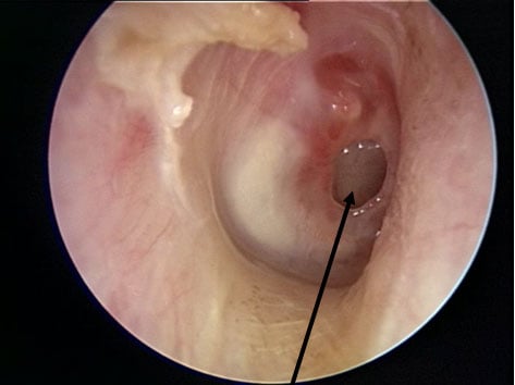 tympanoplasty