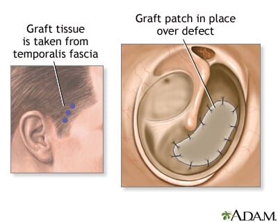 tympanoplasty