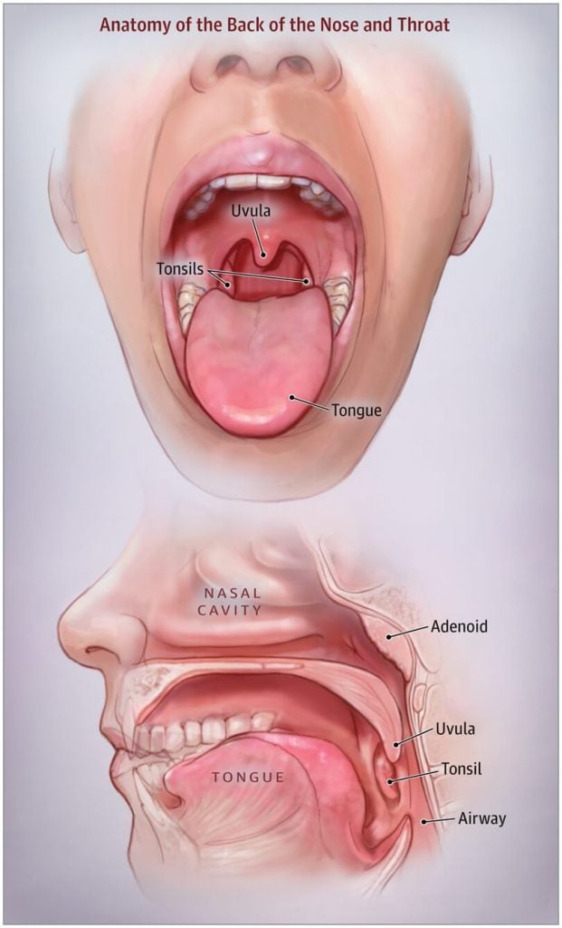 Tonsillectomy