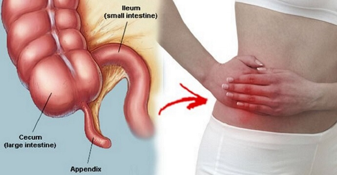 Appendix removal