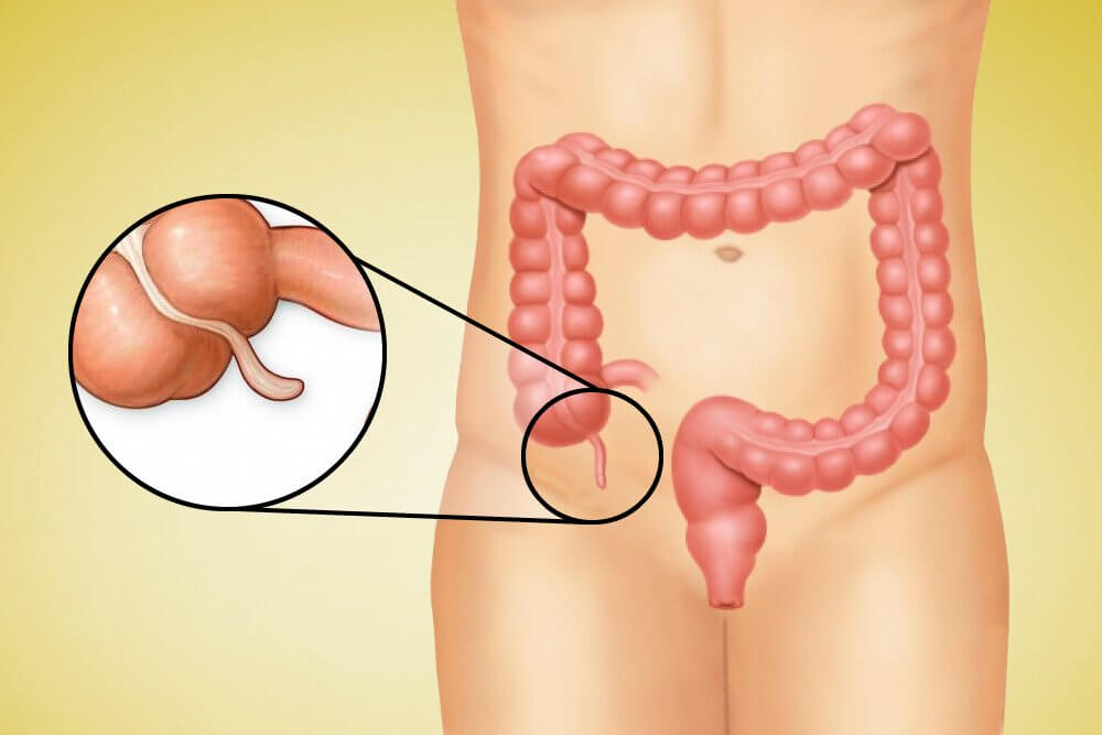Appendix removal
