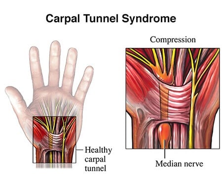 Carpal Tunnel Syndrome