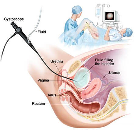 Cystoscopes Test