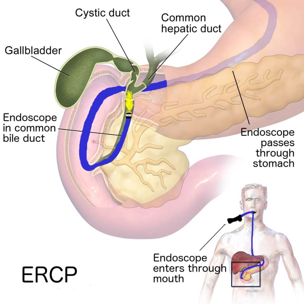 ERCP ( endoscopic retrograde cholangiopancreatography )