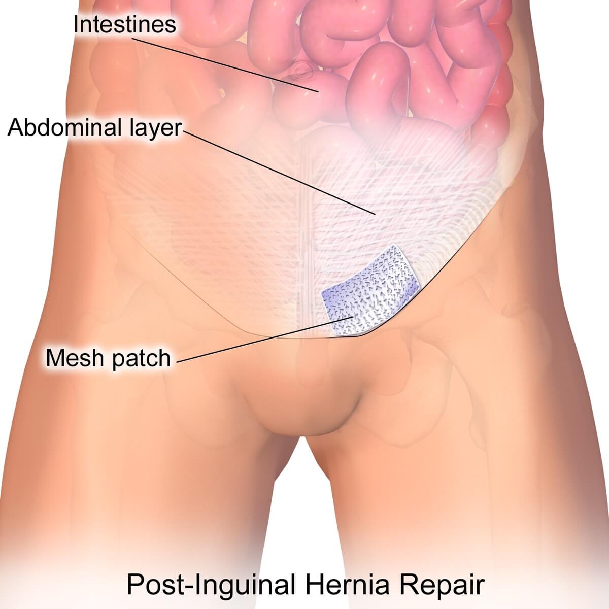 inguinal_hernia_patch