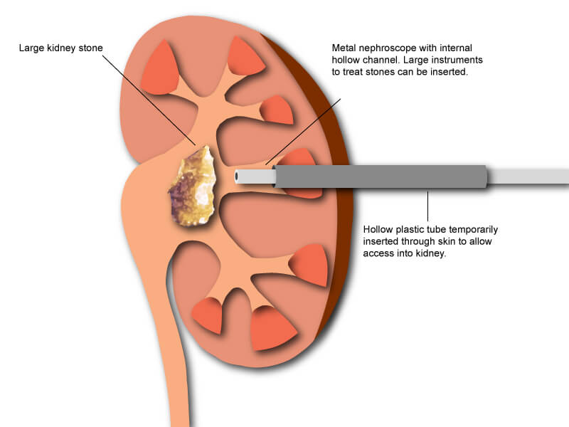 PCNL (percutaneous nephrolithotomy) kidney stone