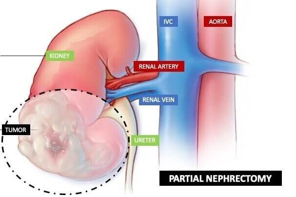 Nephrectomy
