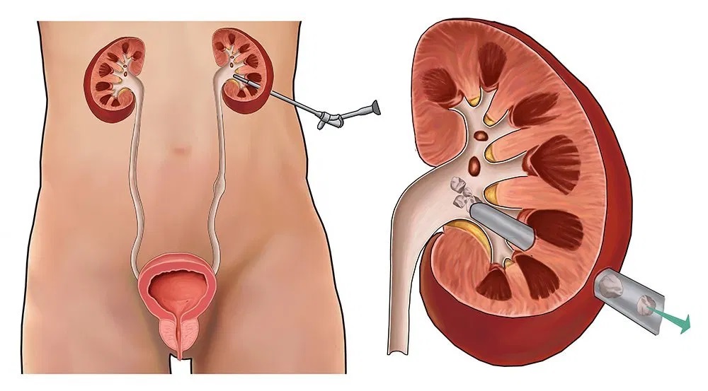 PCNL (percutaneous nephrolithotomy) kidney stone