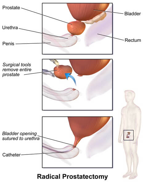 Open Radical Prostatectomy