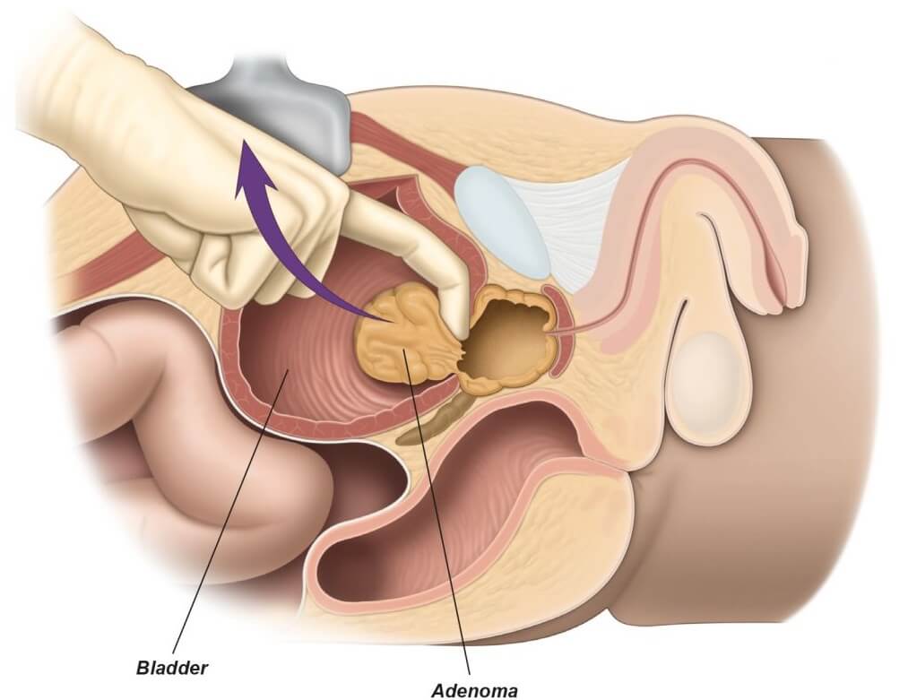 Open Radical Prostatectomy