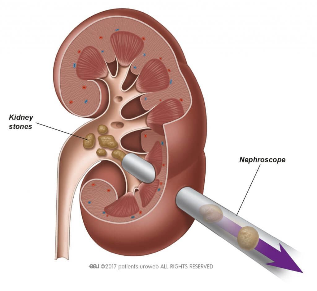 PCNL (percutaneous nephrolithotomy) kidney stone