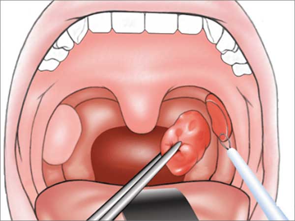 Tonsillectomy