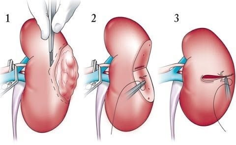 Nephrectomy