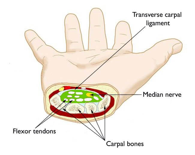 Carpal Tunnel Syndrome