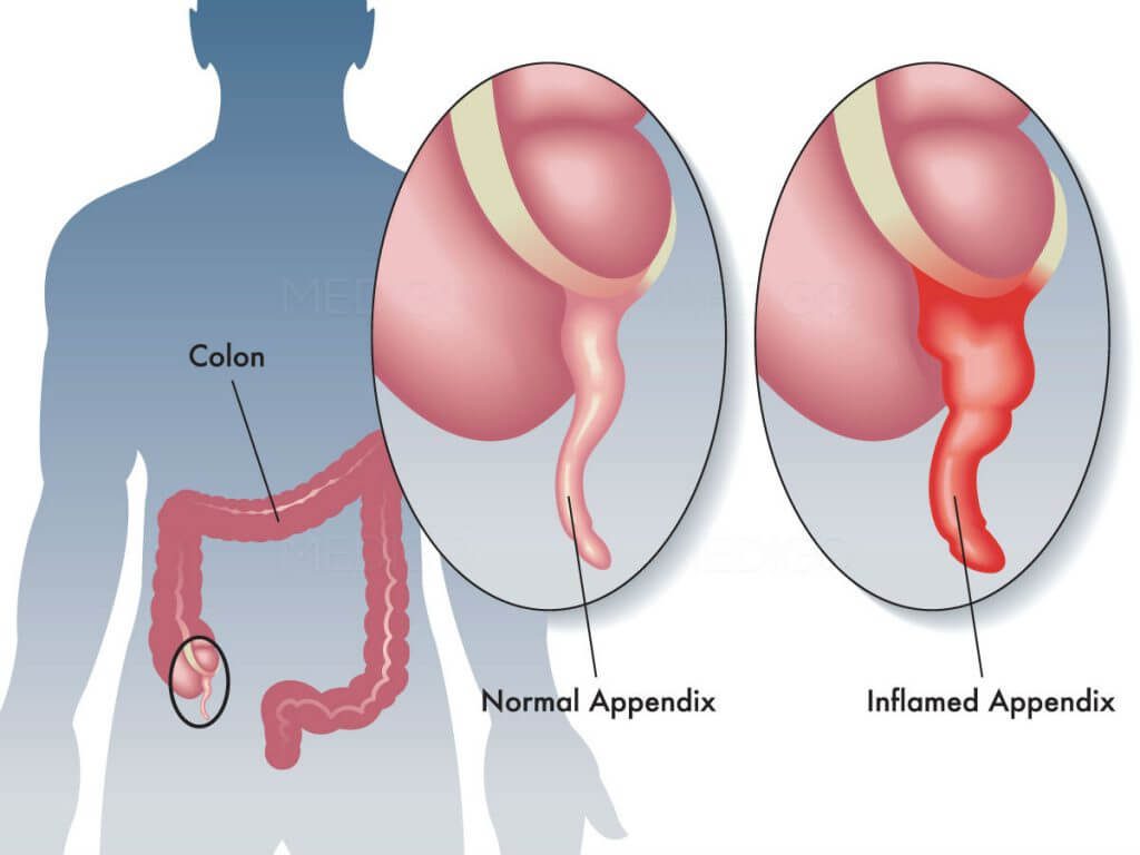 Appendix sebelah mana