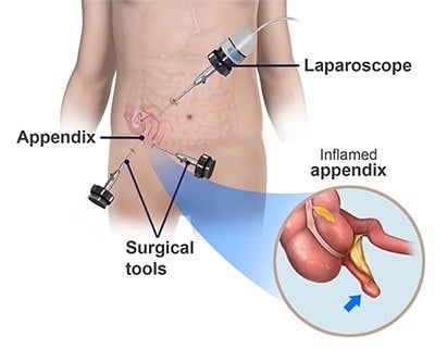 Appendix removal