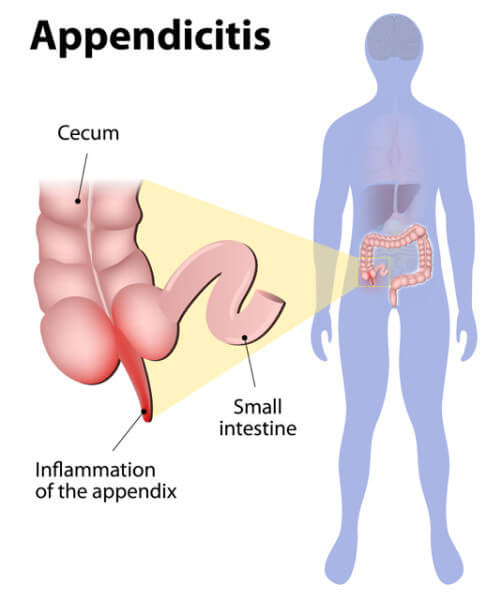 Appendix removal