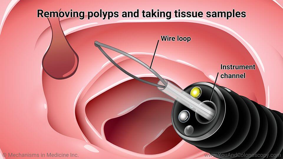 Colonoscopy