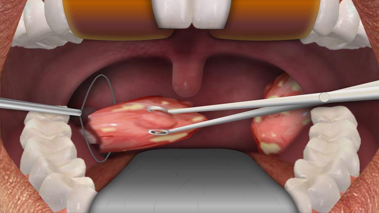 tonsils removed