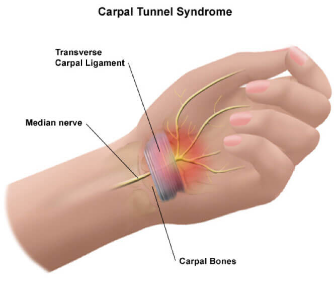 carpal-tunnel-release