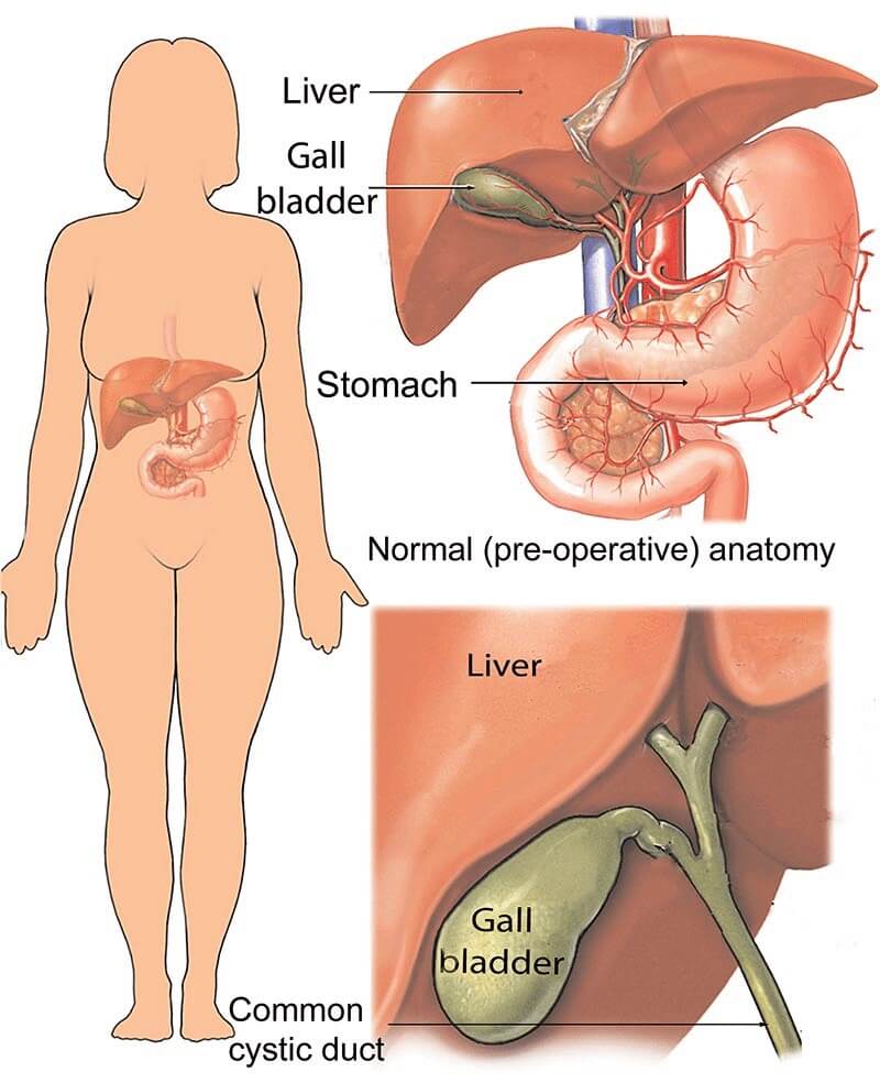 Open cholecystectomy surgery
