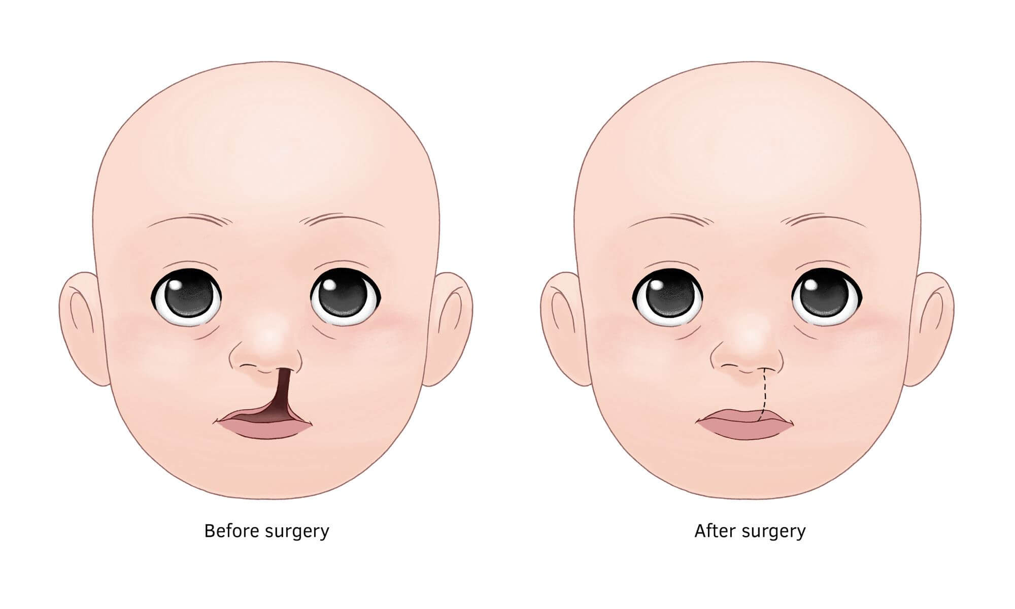 co026_cleft_lip_and_palate_img2_au