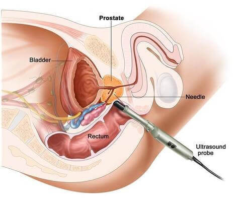 Open Radical Prostatectomy