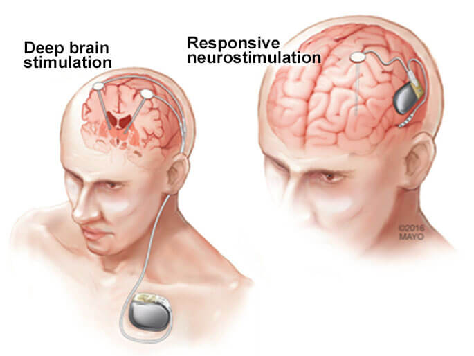 Deep brain stimulation (DBS)