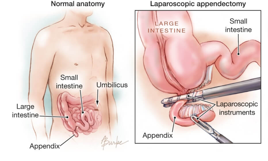 Appendix removal