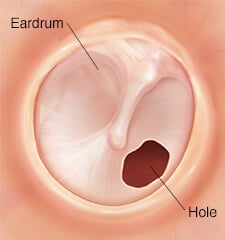 tympanoplasty