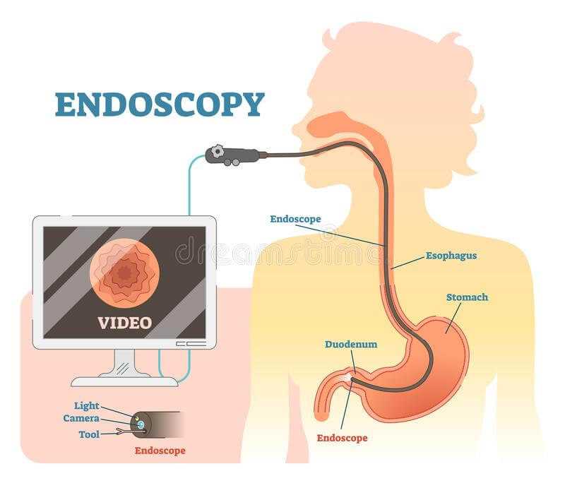 endoscopy-anatomical-vector-illustration-diagram-medical-scheme-endoscope-monitoring-esophagus-stomach-110011650