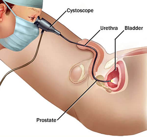 Cystoscopes Test