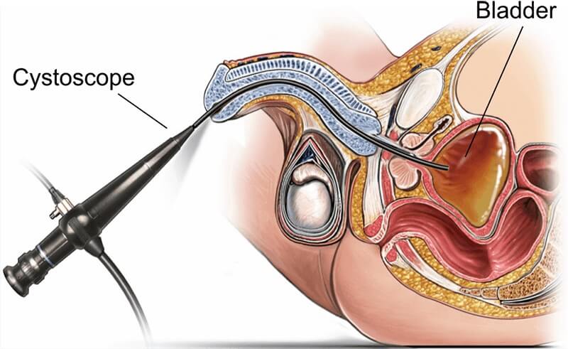 Cystoscopy