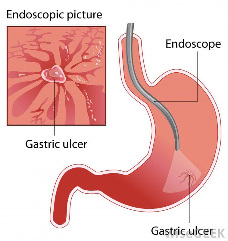 endoscopy