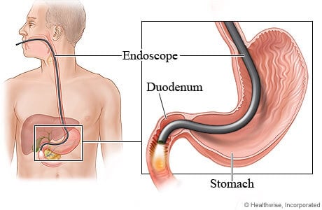 gastroscopy