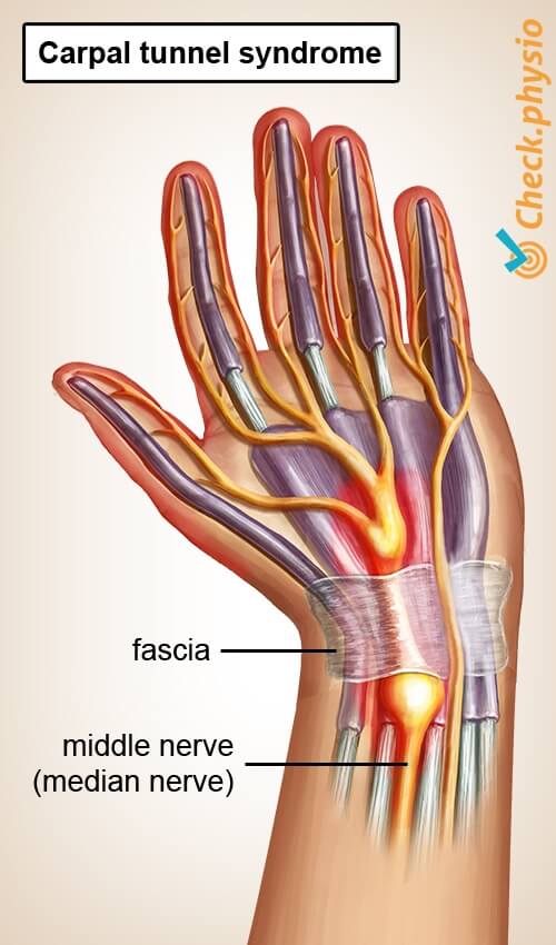 Carpal Tunnel Syndrome