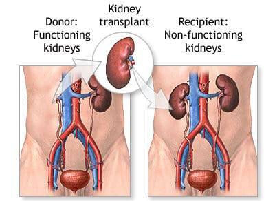 Nephrectomy