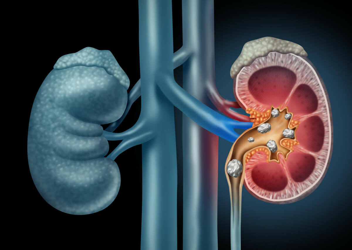 PCNL (Percutaneous Nephrolithotomy) Surgery