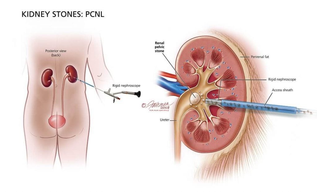 PCNL (percutaneous nephrolithotomy) kidney stone