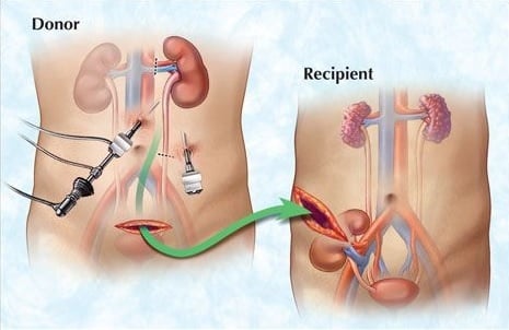 Nephrectomy