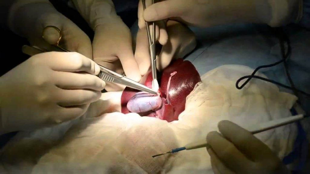 Open cholecystectomy surgery